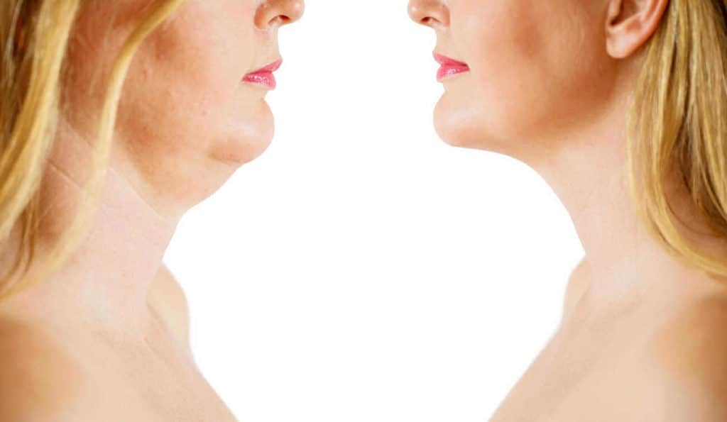 Double Chin treatment Collier's Wood before and after results