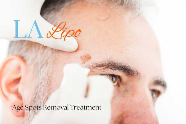 What Are the Most Effective Treatments for Age Spots Collier's Wood?