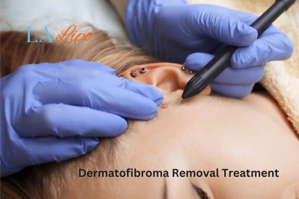 Dermatofibroma Removal Treatment Collier's Wood