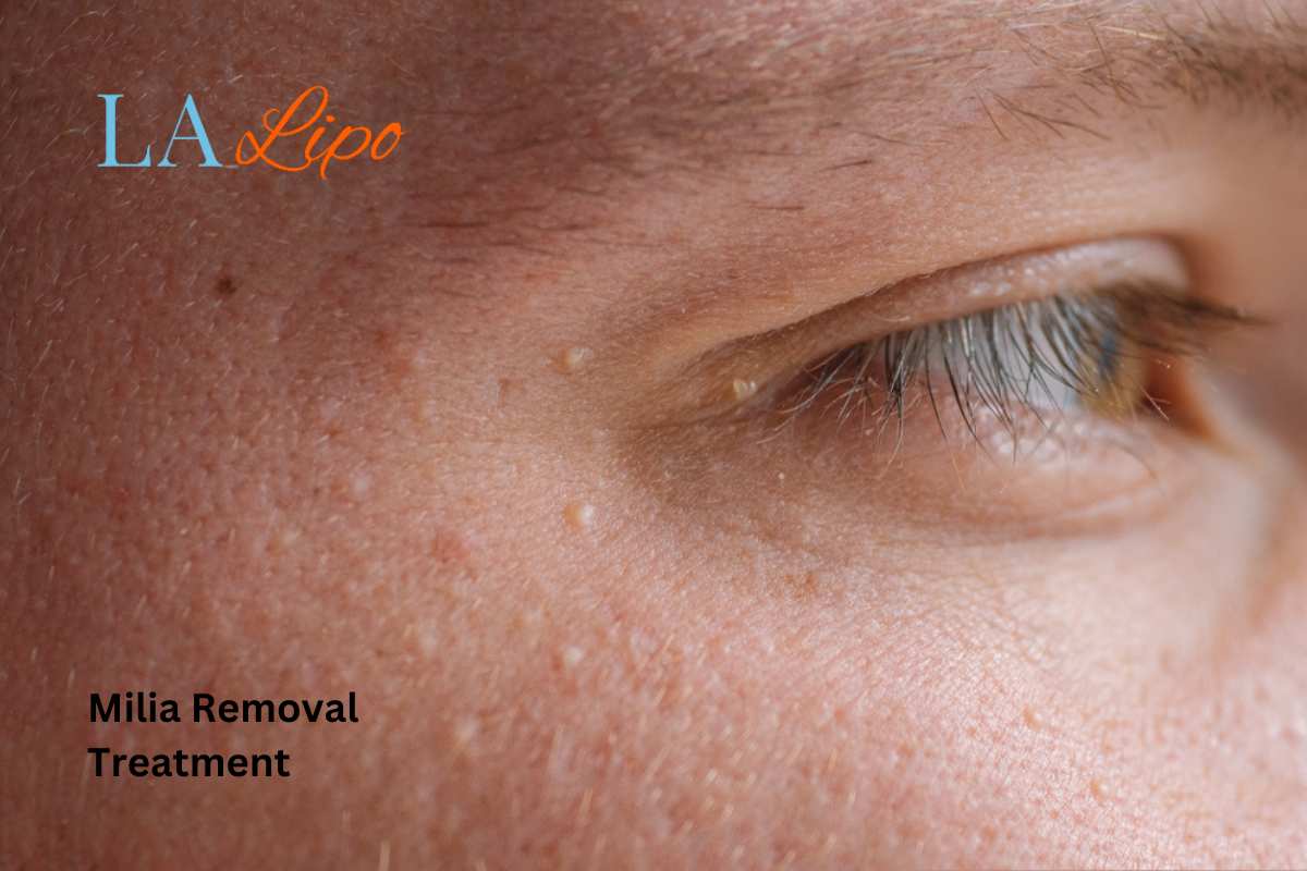 Cryopen Milia Removal: Is It the Easiest and Safest Option Collier's Wood?