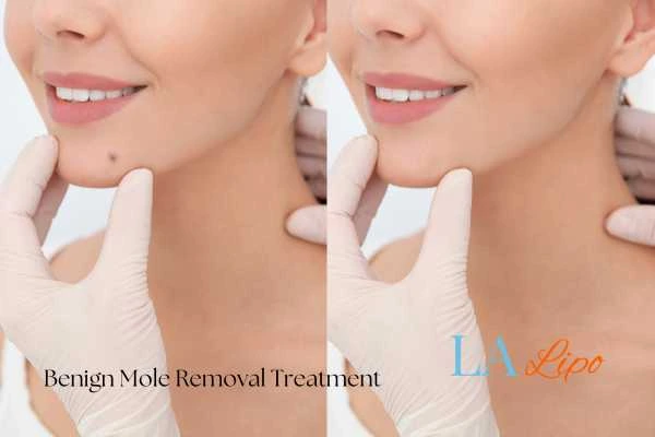 woman's before and after mole removal Collier's Wood results
