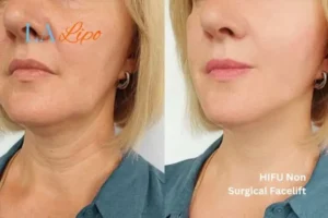 hi-fu for wrinkles Collier's Wood before and after results