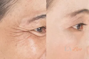 Before and after results of woman - HI-fu wrinkles reduction treatment Collier's Wood
