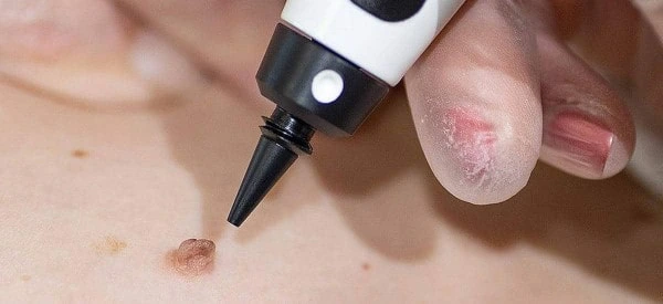 skin tag removal using cryopen Collier's Wood
