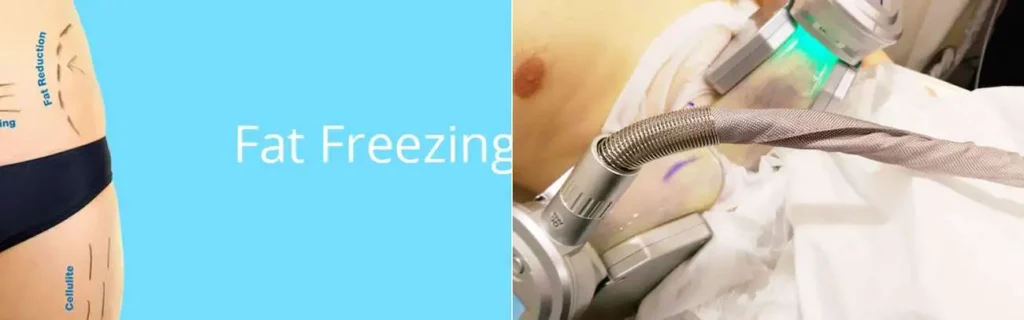 Fat freezing Collier's Wood on multiple areas of the body