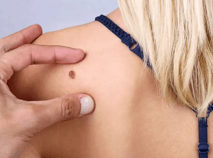 woman having mole removal Collier's Wood consultation before treatment.