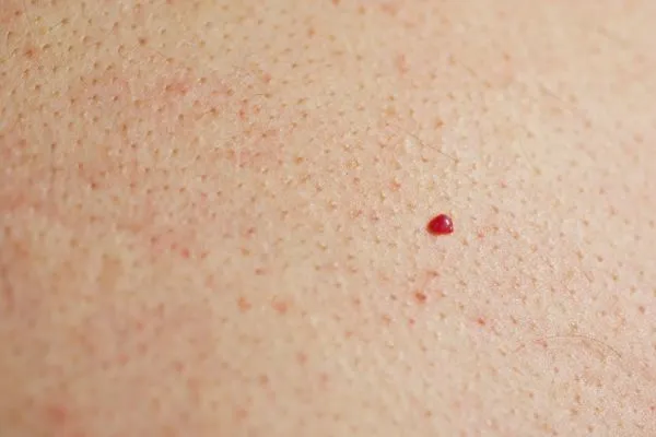 close up of a cherry angioma Collier's Wood