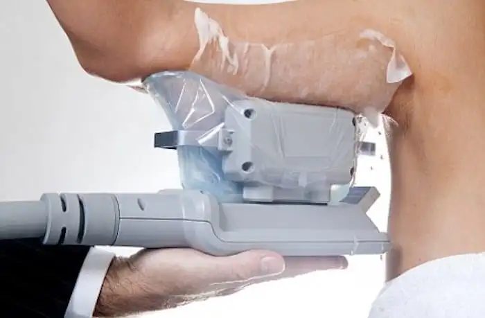 Picture of fat freezing Collier's Wood on the upper arms.