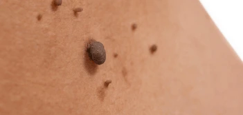 image of a skin tag Collier's Wood