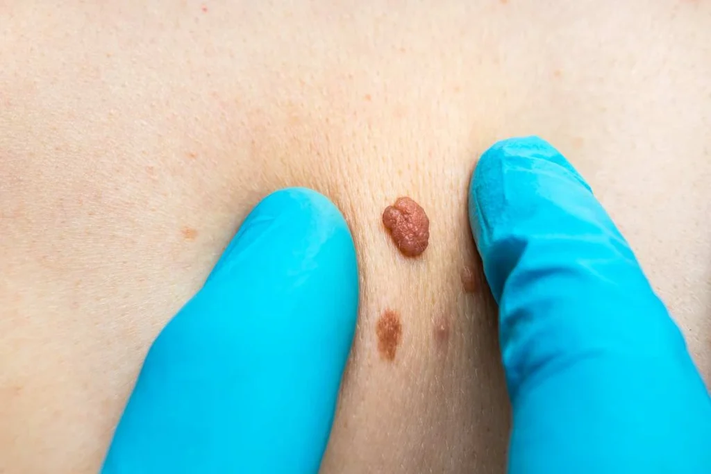 Consultant examining a skin tag Collier's Wood