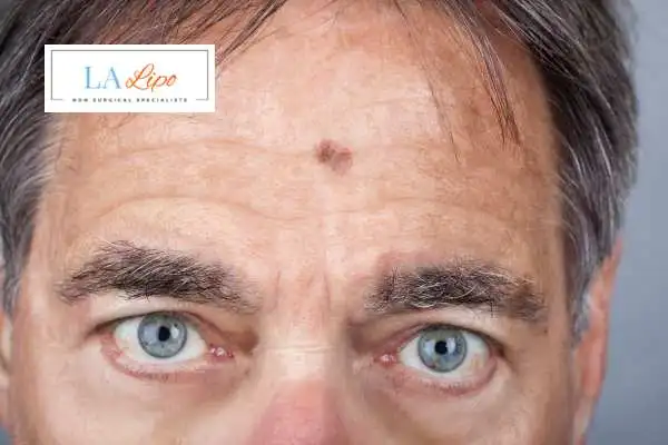 Solar Lentigo Removal Collier's Wood image of man with mark on his forehead