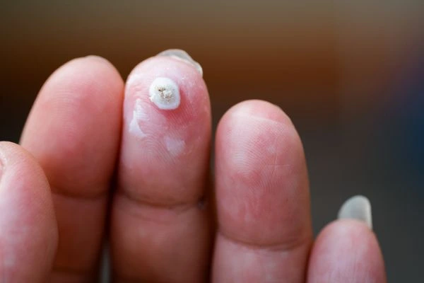 wart on person finger - cryotherapy to treat from LA LIPO Collier's Wood