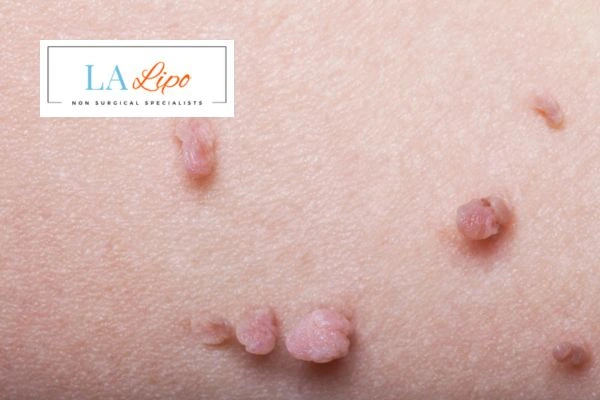 Does cryopen skin tag removal Collier's Wood hurt? Find out now call our team today!