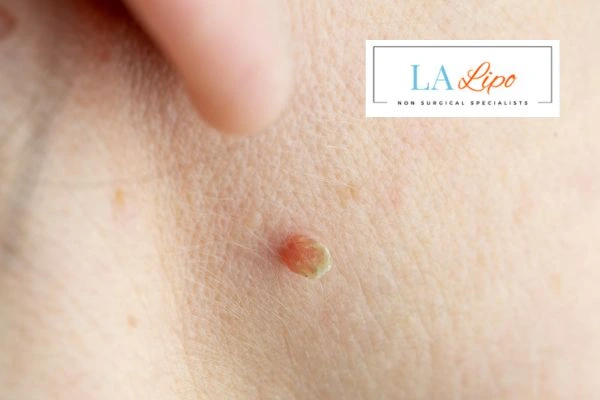 Book skin tag removal Collier's Wood today speak to our team now!