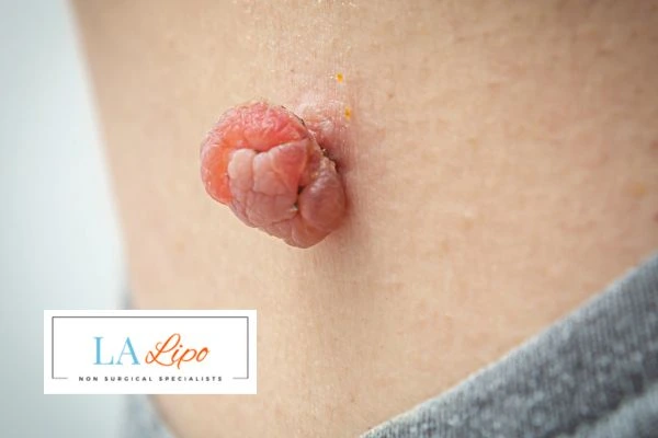 Interested in skin tag removal Collier's Wood? Concerned about the pain? Find out more today!