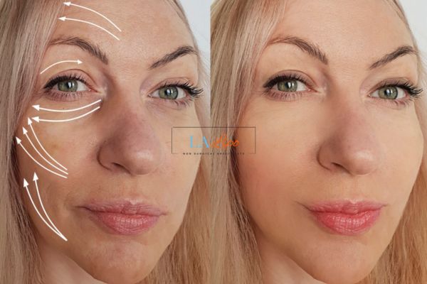 Morpheus 8 results Collier's Wood face lift.