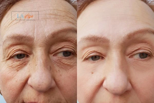 The powerful benefits of Morpheus8 Treatment Collier's Wood - Call Our team today!