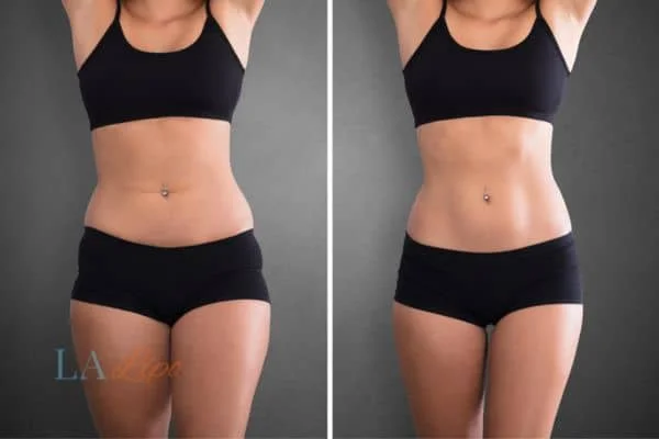 before and after results of non-surgical treatment to help a woman's body image and mental health Collier's Wood