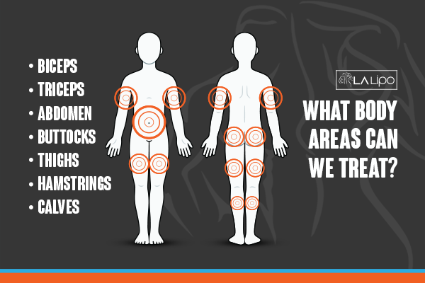 Diagram to show areas you can have LA-EMS Body Sculpting Treatment Collier's Wood