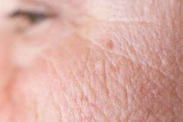 close up picture of a woman's face showing an age spot Collier's Wood