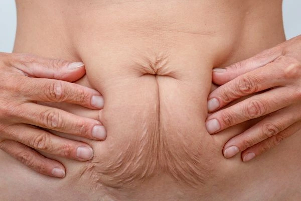 Image of a woman's stomach with loose skin - example of skin tightening Collier's Wood options