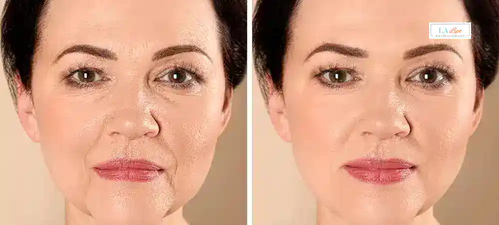 How Long Does It Take to See Results and How Long Do They Last Collier's Wood?
