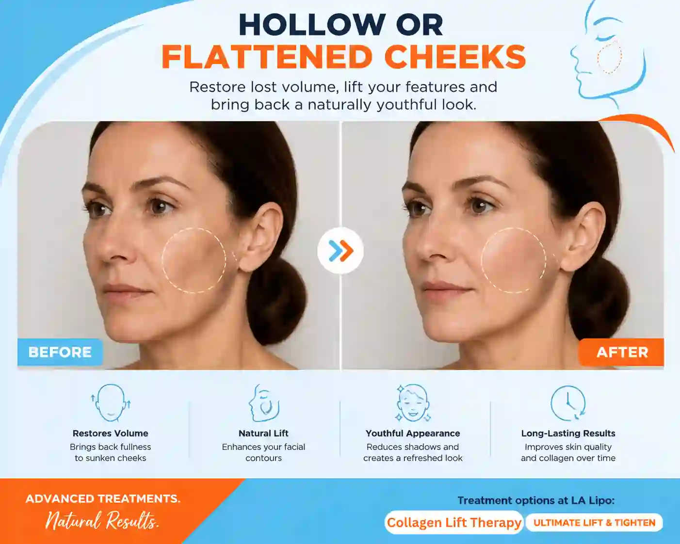 Sign #4: Hollow or Flattened Cheeks Collier's Wood